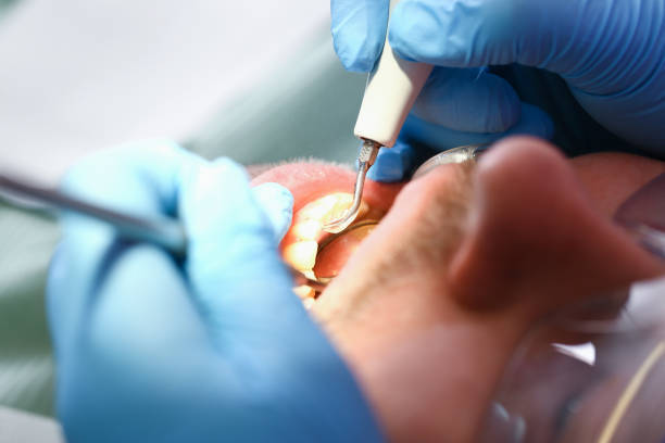 Best Emergency Wisdom Teeth Removal in Bal Harbour, FL